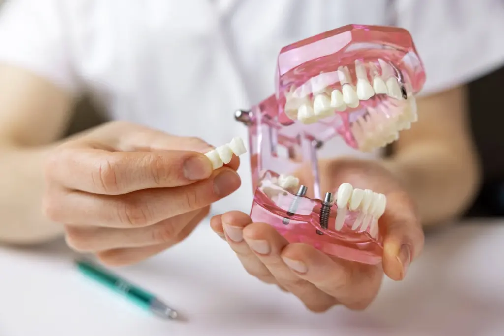 Dental Implant Cases