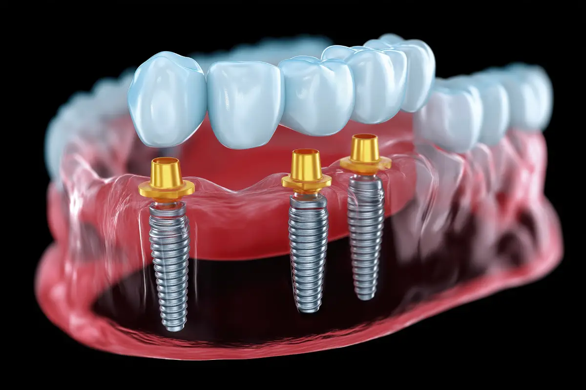 All-on-X Dental Implants